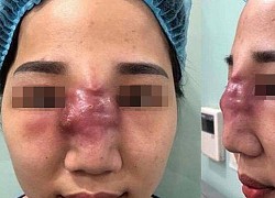 Hậu quả tiêm filler: Thủng ngực, mất mũi, hủy dung nhan... nhưng chị em "không chịu cảnh tỉnh"