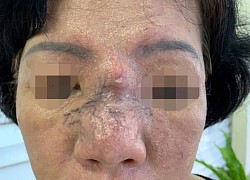 Thủng ngực, mất mũi vì tiêm filler làm đẹp, bác sĩ cũng ngán sợ