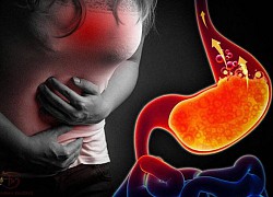 Bác sĩ chuyên khoa cảnh báo 10 dấu hiệu của trào ngược dạ dày: Thói quen ăn uống, lịch sinh hoạt là đặc biệt quan trọng khi đối phó với căn bệnh này
