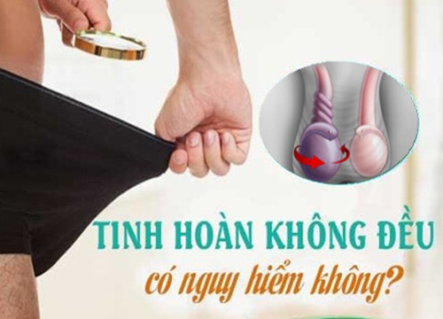 Lo lắng bởi tinh hoàn không đều