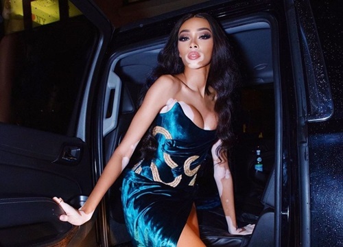 Váy áo giúp người mẫu bạch biến Winnie Harlow tỏa sáng