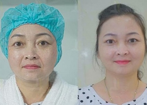 Thẩm Mỹ Viện Quốc Tế Venus tiên phong áp dụng công nghệ Căng da Mediwire tại Việt Nam