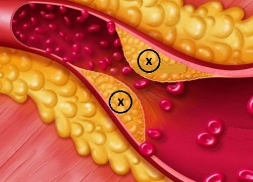 Rối loạn lipid máu là gì: Nguyên nhân, triệu chứng và chuẩn đoán điều trị như thế nào?