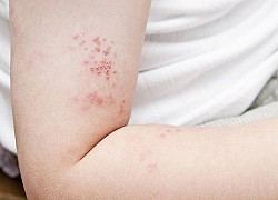 Mắc zona thần kinh điều trị bao lâu thì khỏi?
