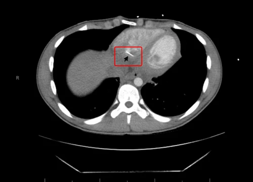 Thiếu niên 17 tuổi nuốt phải kim khâu, 3 ngày sau nhập viện vì đau tim