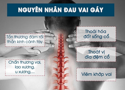 Đau vai gáy là bệnh gì? Nguyên nhân gây bệnh và các hướng điều trị