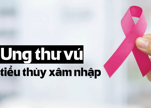 Ung thư vú tiểu thùy xâm nhập: Nguyên nhân, triệu chứng, chẩn đoán và phương pháp điều trị