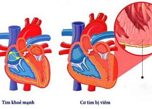 Bệnh nhân COVID-19 đã hồi phục vẫn có thể bị ảnh hưởng tim