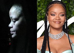 Dân tình tá hỏa trước loạt ảnh Rihanna mặt bầm tím khi xuống phố, đại diện mãi mới hé lộ về vụ tai nạn mới đây