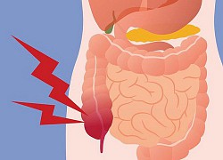 Bệnh lý viêm ruột thừa, bác sĩ sợ nhất hai từ "quá muộn"