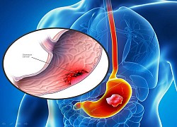 19, 20 tuổi đã bị ung thư dạ dày: Người trẻ đừng bỏ qua 'thời gian vàng' của bệnh