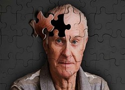 Alzheimer và những dấu hiệu sớm cần lưu ý