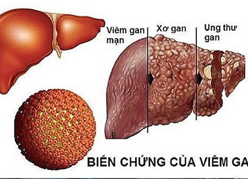 Hầu hết những triệu chứng sớm của loại ung thư phổ biến nhất ở nam giới đều bị bỏ qua