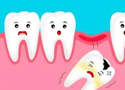 Người đàn ông 31 tuổi đi khám vì răng lung lay, bác sĩ quyết định nhổ tất cả răng vì sai lầm từ 2 năm trước của anh