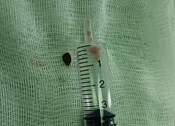 Mảnh gỗ nằm trong má suốt 14 năm mà không biết