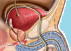 Nang tuyến tiền liệt có thành ung thư?