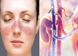 Thuốc mới trị viêm thận lupus: Nhiều bất lợi cần chú ý khi sử dụng