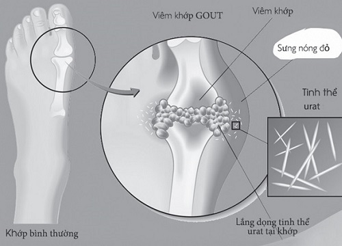 Đối phó với tăng acid uric máu ở người cao tuổi