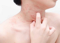 Sốc phản vệ do tự ý mua thuốc điều trị viêm họng về uống, bác sĩ nói gì?