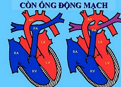 Còn ống động mạch: Bệnh tim bẩm sinh đáng ngại