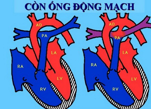 Còn ống động mạch: Bệnh tim bẩm sinh đáng ngại