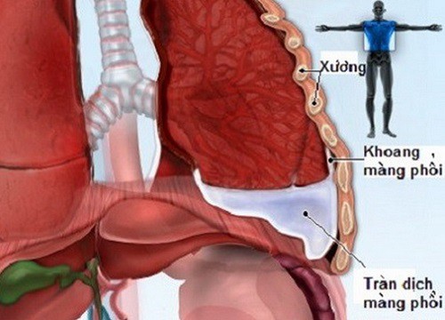 Tràn dịch màng phổi, do đâu?