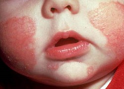 3 điều khiến bệnh eczema tệ hơn