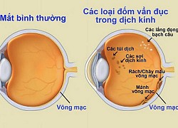 Vẩn đục dịch kính &#8211; khi nào cần đến bác sĩ?