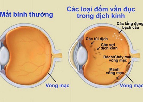 Vẩn đục dịch kính - khi nào cần đến bác sĩ?