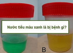 Điều gì xảy ra khi nước tiểu màu đỏ, trắng hoặc xanh, đó có phải dấu hiệu ung thư?