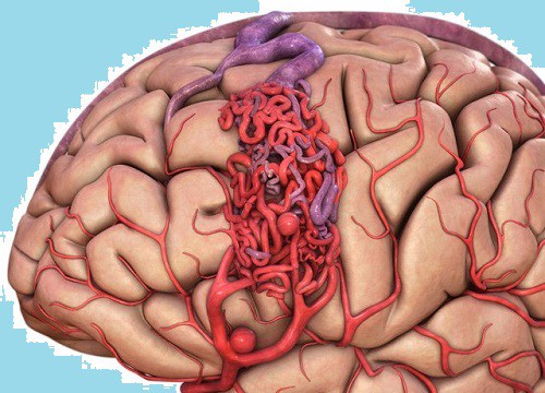 Quảng Nam: Cứu sống một bệnh nhân dị dạng mạch máu não nguy hiểm