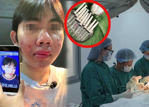 Cả xóm mua si-li-côn ngoài chợ về tự truyền, trào chỗ nào dán keo 502 chỗ đó