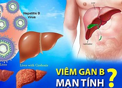 Khi nào bệnh viêm gan B chuyển sang giai đoạn mạn tính