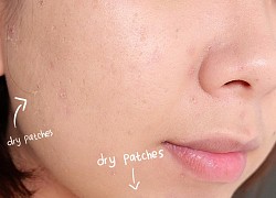 SỰ THẬT: Retinol dùng với da khô có thể gây kích ứng gấp đôi?