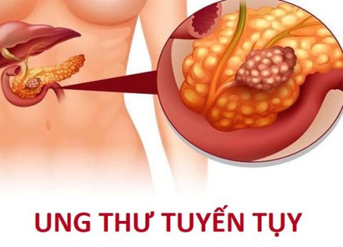 Ung thư tụy: Phát hiện như thế nào?