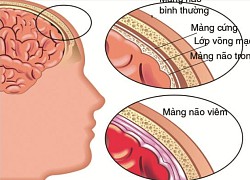 Viêm não mủ quật ngã em bé chỉ sau một ngày