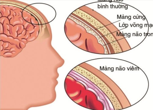 Viêm não mủ quật ngã em bé chỉ sau một ngày