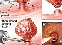 5 dấu hiệu cảnh báo polyp đại trực tràng