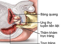 Dấu hiệu ung thư tiền liệt tuyến dễ nhầm với phì đại thông thường