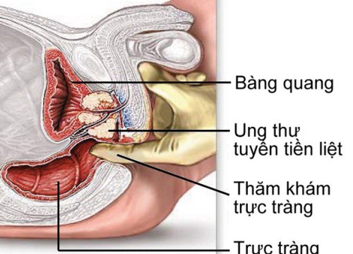 Dấu hiệu ung thư tiền liệt tuyến dễ nhầm với phì đại thông thường