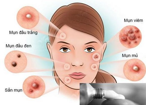 Mụn trứng cá: Nguyên nhân và thuốc điều trị