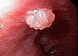 Cứ nhiễm HPV là có nguy cơ ung thư?