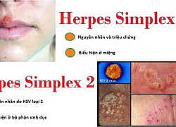 Herpes dễ nhầm lẫn với 4 bệnh ở đường sinh dục