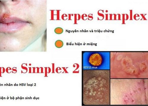 Herpes dễ nhầm lẫn với 4 bệnh ở đường sinh dục