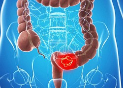 Hướng đi mới trong điều trị bệnh viêm ruột và ung thư