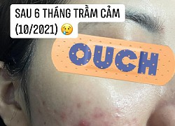 Lại một trường hợp peel da muốn "khóc thét": Gương mặt xinh đẹp biến dạng như bị tạt axit, tất cả vì sự chủ quan này