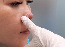 Tiêm filler nâng mũi ở spa, một phụ nữ ở TP.HCM bị biến chứng hoại tử