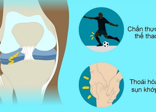 Tổn thương hay gặp ở khớp gối và cách chữa trị