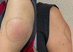 'Cánh tay COVID' tác dụng phụ hiếm gặp sau tiêm vaccine COVID-19