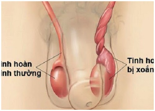 Nam giới chớ chủ quan với xoắn tinh hoàn